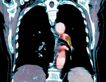 Image: Colored coronal computer tomography (CT) scan of a pulmonary embolism (Photo courtesy of Du Cane Medical Imaging).